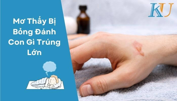 Mơ Thấy Bị Bỏng Đánh Con Gì Trúng Lớn